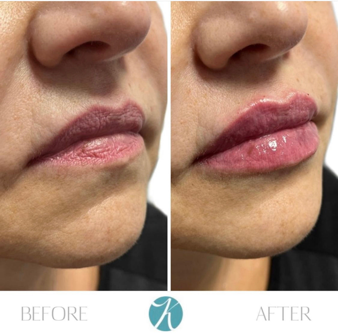 Package of 2 Fillers