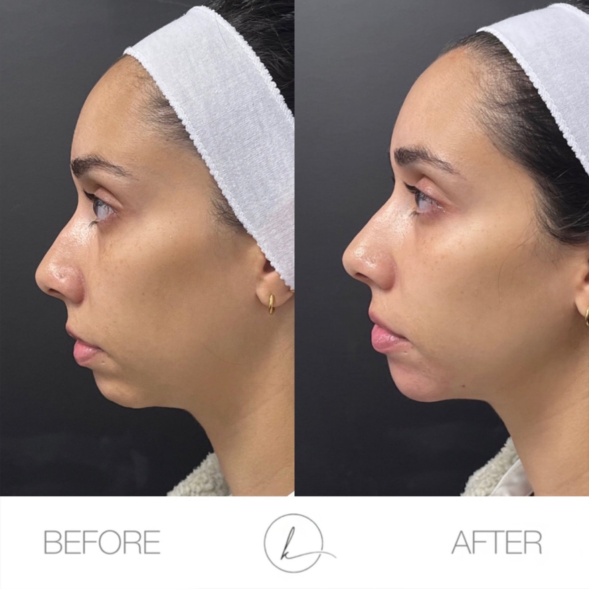 Package of 3 Fillers