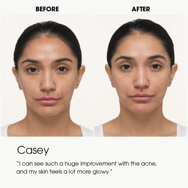 Nutrafol - Clear Skin Nutraceutical (90 Day Supply)