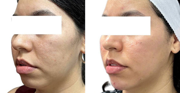 Package of 4 Fillers