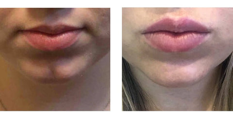 Package of 6 Fillers