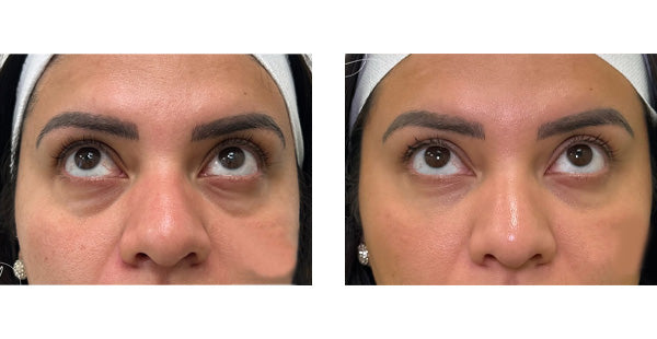Package of 8 Fillers
