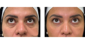 Package of 8 Fillers